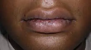 Dry lips and six (6) other signs of early diabetes