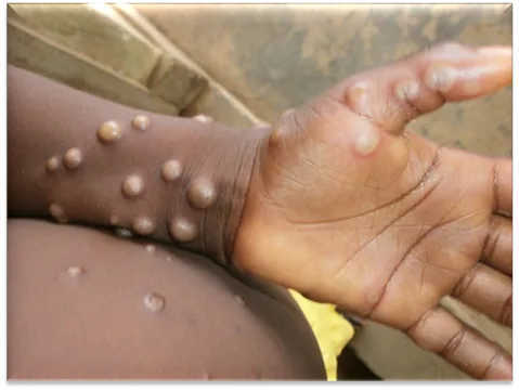 Ghana Confirms Two Cases of Mpox in Accra: What You Need to Know