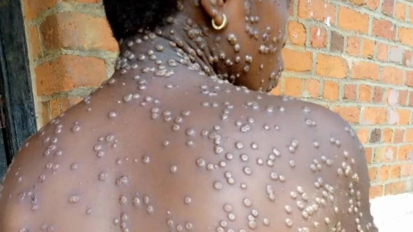 Protect Yourself from Contacting Monkey pox in Ghana