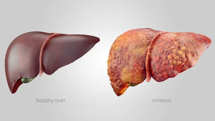 subtle signs your liver is damaged